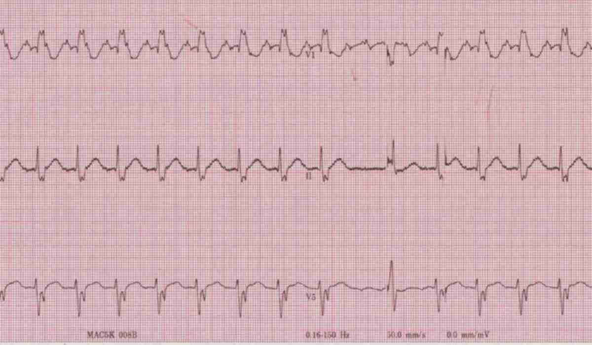 ЕКГ калькулятор